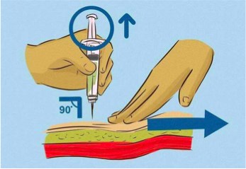 接种疫苗三角肌位置图图片