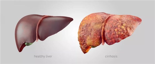 通常只有大于 30%的肝细胞发生脂肪变性时才能被b超发现,ct 发现的